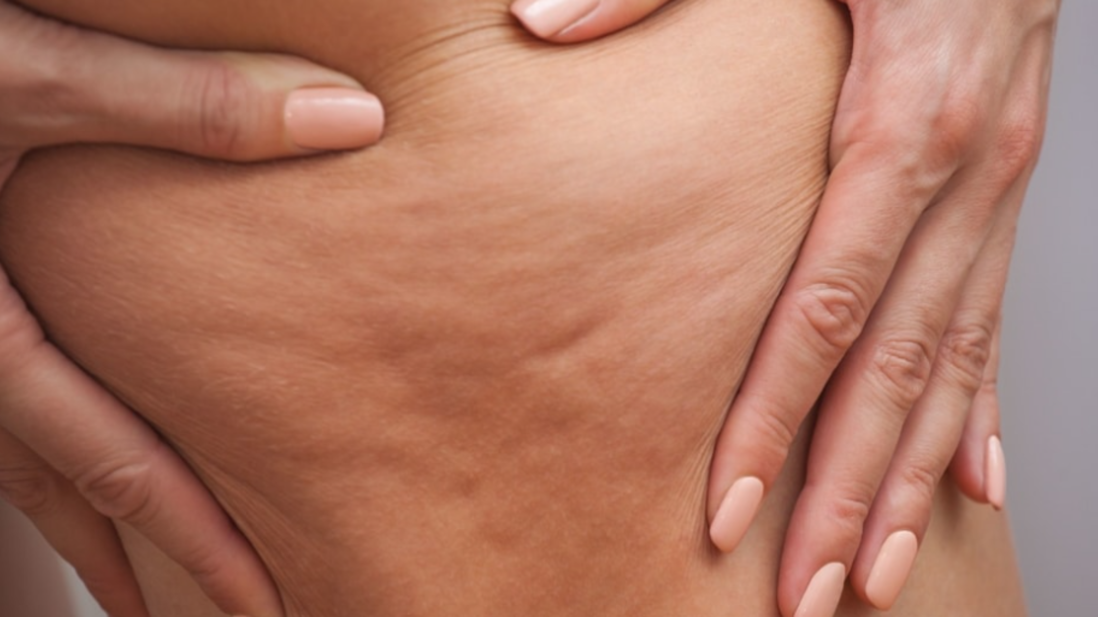 How to tackle cellulite
