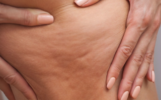 How to tackle cellulite
